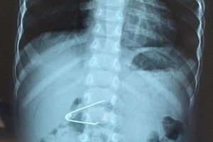 Tin 14/11: Đầu nhọn kim băng bung nắp găm vào dạ dày bé 18 tháng tuổi; lau cửa sổ, người phụ nữ Hà Nội tuột tay rơi từ tầng 5 xuống đất